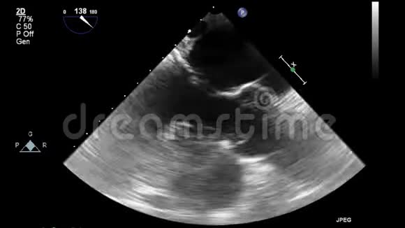 经食管超声检查心脏视频的预览图
