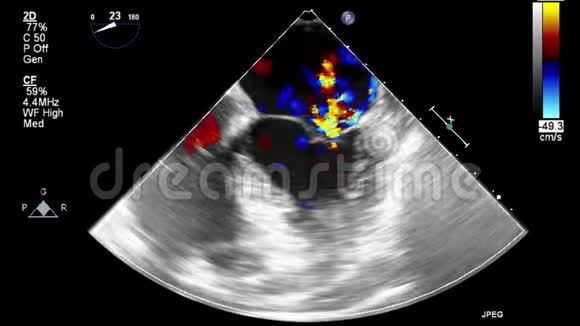 经食管超声检查心脏视频的预览图