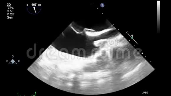 经食管超声检查心脏视频的预览图
