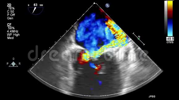 经食管超声检查心脏视频的预览图
