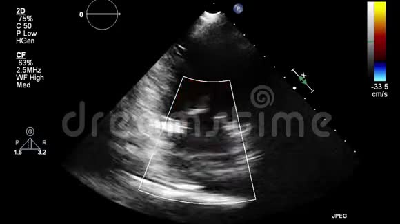经食管超声检查心脏视频的预览图