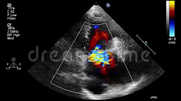 经食管超声检查心脏视频的预览图