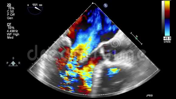 经食管超声检查心脏视频的预览图