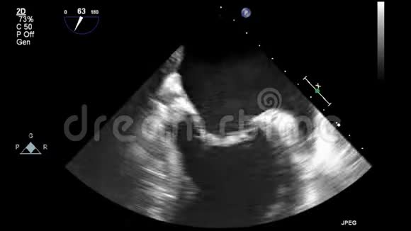 经食管超声检查心脏视频的预览图
