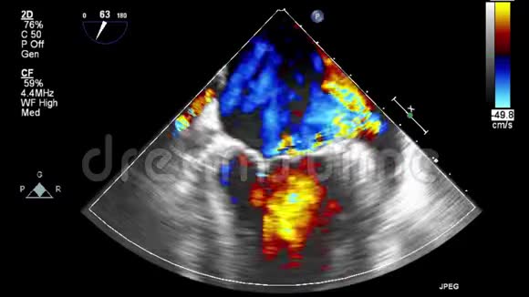 经食管超声检查心脏视频的预览图