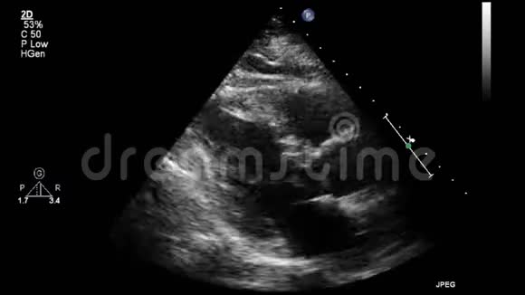 经食管超声检查心脏视频的预览图