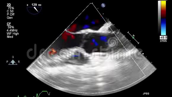 经食管超声检查心脏视频的预览图