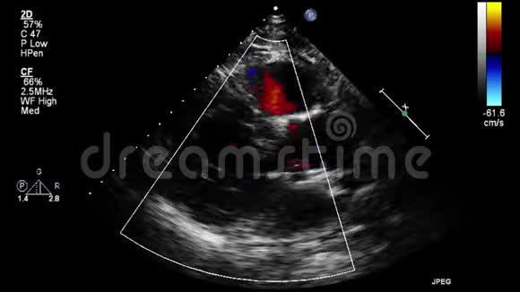 经食管超声检查心脏视频的预览图