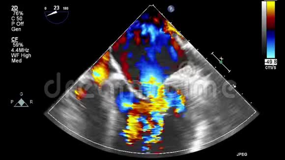经食管超声检查心脏视频的预览图