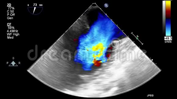 经食管超声检查心脏视频的预览图