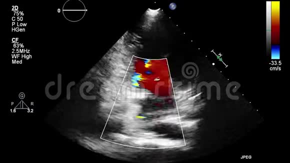 经食管超声检查心脏视频的预览图