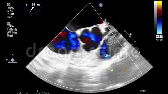 经食管超声检查心脏视频的预览图