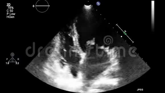 经食管超声检查心脏视频的预览图