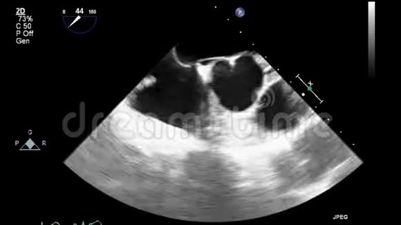 经食管超声检查心脏视频的预览图