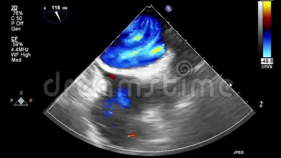 经食管超声检查心脏视频的预览图