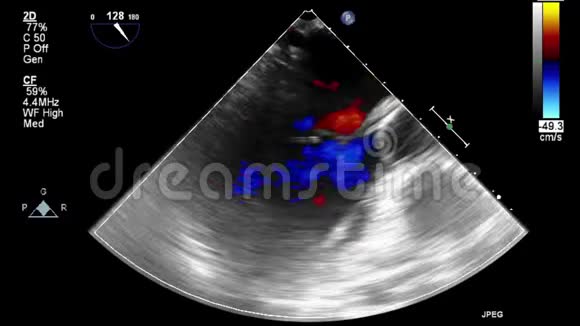 经食管超声检查心脏视频的预览图