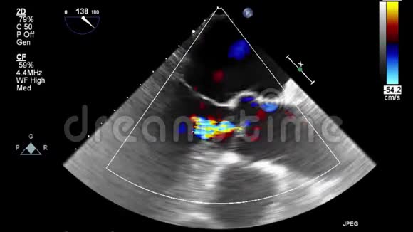 经食管超声检查心脏视频的预览图