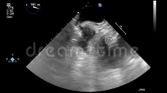 经食管超声检查心脏视频的预览图