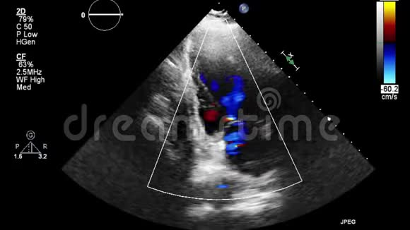 经食管超声检查心脏视频的预览图