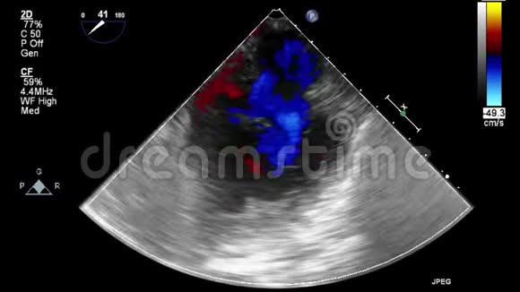 经食管超声检查心脏视频的预览图