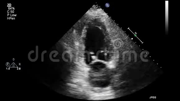 高质量的经食道灰阶超声影像视频的预览图