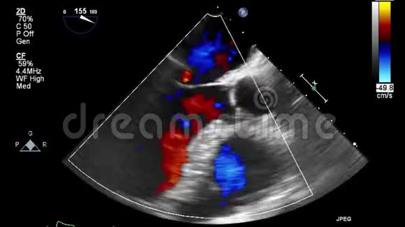 多普勒模式下高质量的经食管超声视频视频的预览图