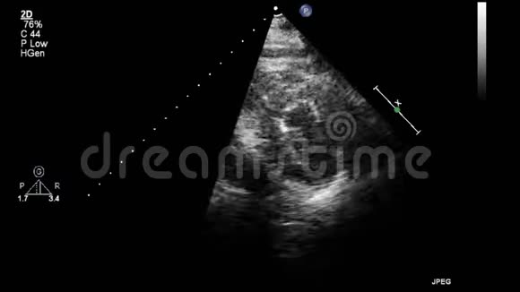高质量的经食道灰阶超声影像视频的预览图