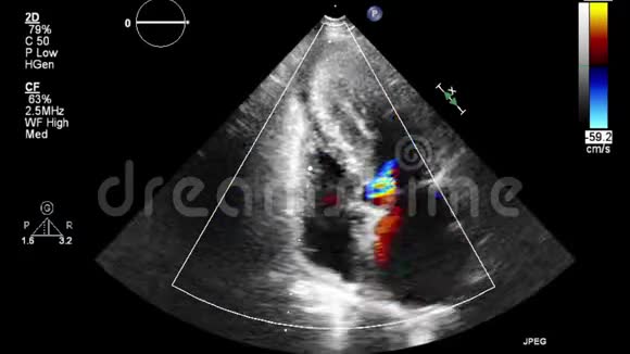 多普勒模式下高质量的经食管超声视频视频的预览图