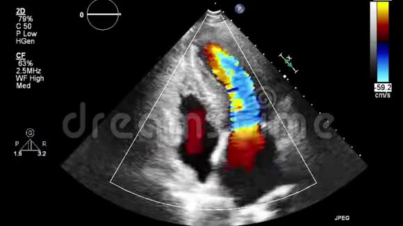 多普勒模式下高质量的经食管超声视频视频的预览图