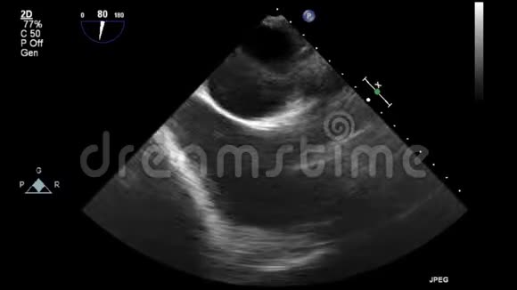 优质视频超声经食管检查心脏视频的预览图