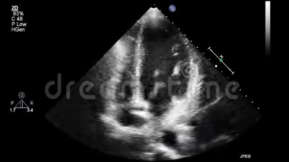 优质视频超声经食管检查心脏视频的预览图
