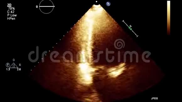 优质视频超声经食管检查心脏视频的预览图