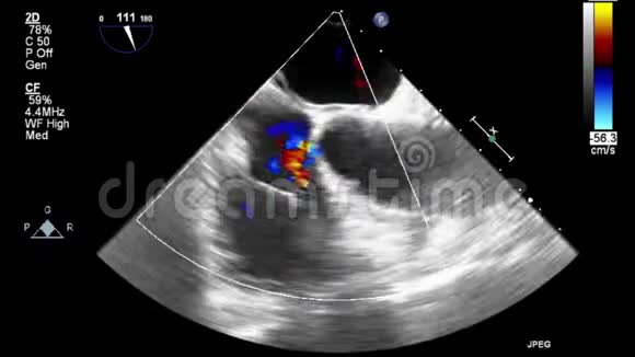 优质视频超声经食管检查心脏视频的预览图