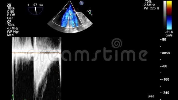 优质视频超声经食管检查心脏视频的预览图