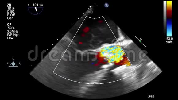 优质视频超声经食管检查心脏视频的预览图