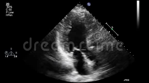 高质量的经食道灰阶超声影像视频的预览图