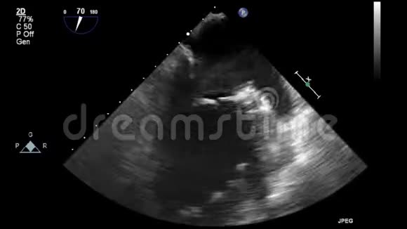 优质视频超声经食管检查心脏视频的预览图