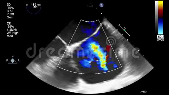优质视频超声经食管检查心脏视频的预览图
