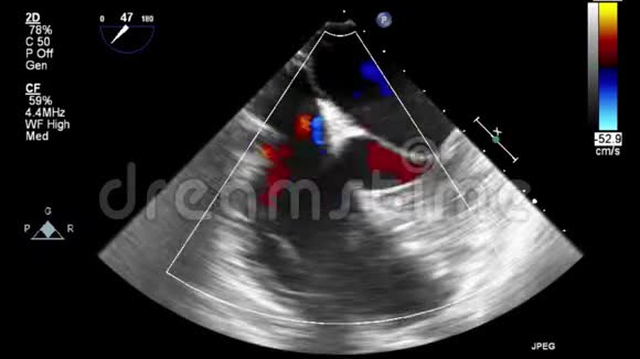 优质视频超声经食管检查心脏视频的预览图
