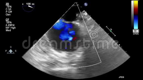 优质视频超声经食管检查心脏视频的预览图
