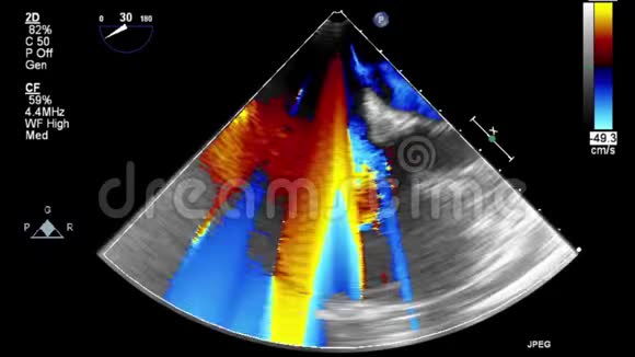 优质视频超声经食管检查心脏视频的预览图