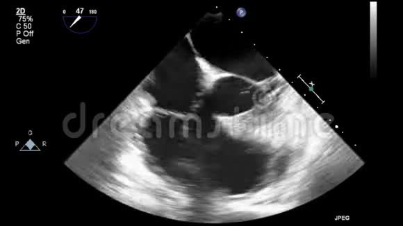 优质视频超声经食管检查心脏视频的预览图