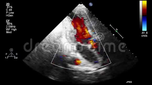 优质视频超声经食管检查心脏视频的预览图