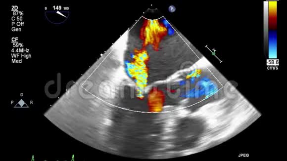 优质视频超声经食管检查心脏视频的预览图