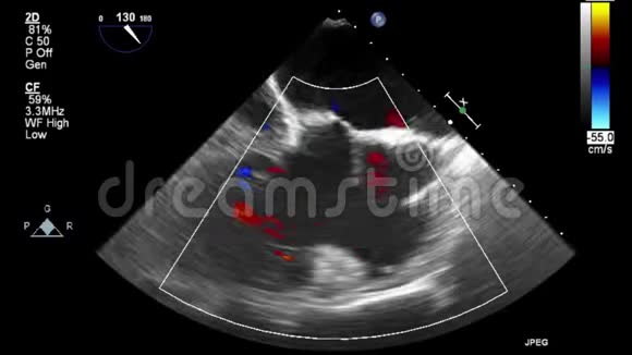 优质视频超声经食管检查心脏视频的预览图