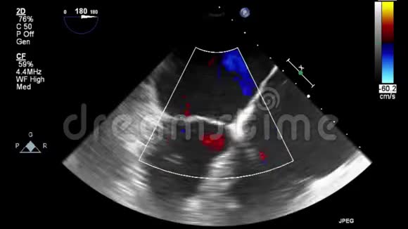 优质视频超声经食管检查心脏视频的预览图