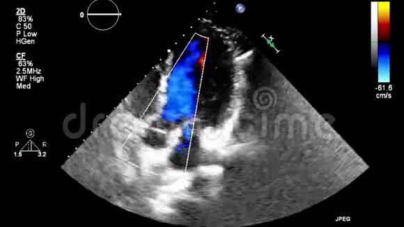 优质视频超声经食管检查心脏视频的预览图