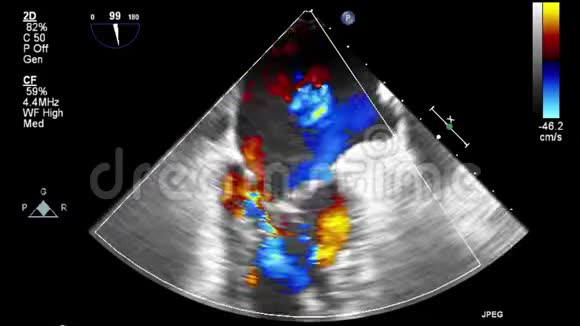 优质视频超声经食管检查心脏视频的预览图