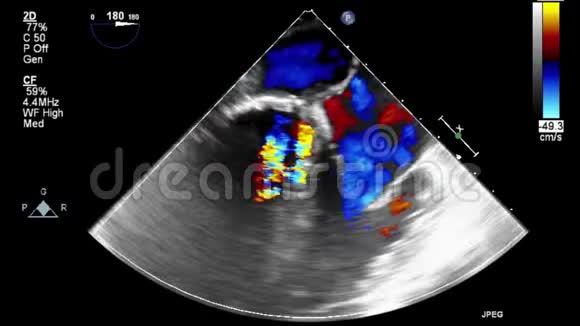 优质视频超声经食管检查心脏视频的预览图