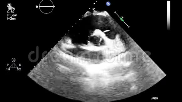 优质视频超声经食管检查心脏视频的预览图